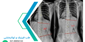 انواع انحرافات ستون فقرات