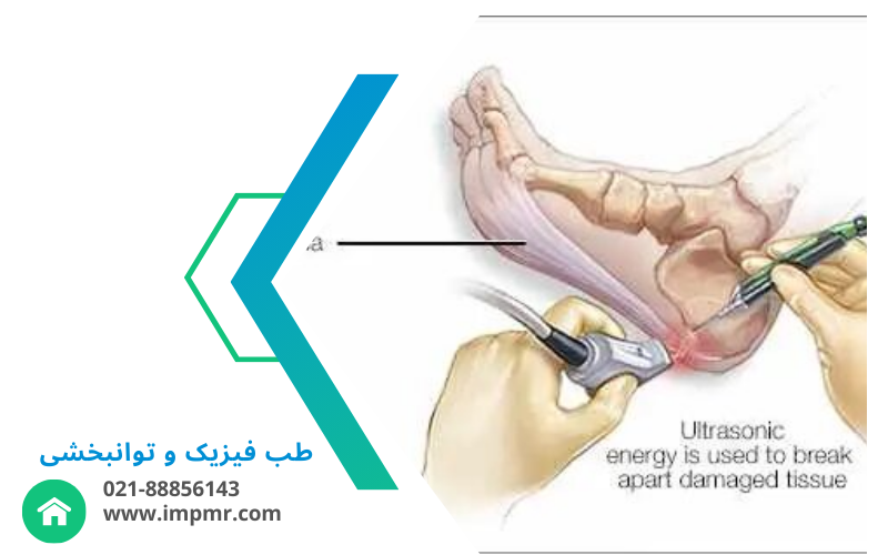 علت درد پاشنه چیست