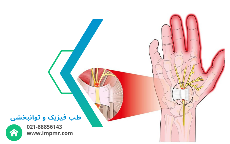 سندروم تونل کارپال چیست؟