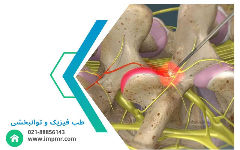 رادیو فرکانسی دیسک کمر یکی از روش‌های پیشرفته و کم تهاجمی در درمان دردهای مزمن کمر است. این روش با استفاده از امواج رادیویی با فرکانس بالا، به کاهش دردهای مزمن ناشی از مشکلات دیسک کمر و آسیب‌های مرتبط با اعصاب ستون فقرات کمک می‌کند. هدف از این درمان، مسدود کردن انتقال سیگنال‌های درد به مغز است و به بیمار کمک می‌کند تا از دردهای طولانی‌مدت رهایی یابد. در این مقاله، علاوه بر توضیح روش درمان، به محدودیت‌ها، مزایا و عوارض احتمالی این روش نیز خواهیم پرداخت. چگونه رادیو فرکانسی دیسک کمر عمل می‌کند؟ در این روش درمانی، پزشک ابتدا با استفاده از تصویربرداری دقیق (مثل فلوروسکوپی یا MRI) محل دقیق آسیب یا التهاب در ستون فقرات را شناسایی می‌کند. سپس سوزنی نازک و خاص به محل مورد نظر وارد شده و امواج رادیویی از طریق این سوزن به ناحیه آسیب‌دیده ارسال می‌شود. این امواج باعث تولید حرارت در اعصاب و بافت‌های اطراف می‌شوند که به کاهش درد و التهاب کمک می‌کند. محدودیت‌ها و موارد منع انجام رادیو فرکانسی دیسک کمر رادیو فرکانسی دیسک کمر برای همه بیماران مناسب نیست. در برخی موارد، این درمان منع دارد. از جمله این موارد می‌توان به موارد زیر اشاره کرد: بیماران حامله: انجام رادیو فرکانسی در دوران بارداری به دلیل اثرات احتمالی بر جنین توصیه نمی‌شود. بیماران با ضربان‌ساز قلبی: افراد دارای ضربان‌ساز قلبی به دلیل احتمال تداخل با دستگاه، باید از این روش خودداری کنند. بیماران با عفونت در محل ورود سوزن: اگر در محل انجام درمان عفونت وجود داشته باشد، انجام رادیو فرکانسی منع دارد. بیمارانی که اختلالات خونریزی‌دهنده دارند یا نمی‌توانند داروهای رقیق‌کننده خون را قطع کنند: این افراد به دلیل خطر خونریزی بیشتر، باید از این روش اجتناب کنند. مزایای رادیو فرکانسی دیسک کمر رادیو فرکانسی دیسک کمر علاوه بر کاهش درد، مزایای دیگری نیز دارد که آن را به گزینه‌ای مناسب برای درمان دردهای مزمن تبدیل می‌کند: کاهش مصرف داروهای ضد درد: این روش می‌تواند نیاز به استفاده از داروهای مسکن را کاهش دهد. کاهش نیاز به جراحی: بسیاری از بیماران با این روش قادر به درمان دردهای خود بدون نیاز به جراحی خواهند بود. کاهش زمان ریکاوری و درد پس از درمان: نسبت به جراحی، رادیو فرکانسی زمان بهبودی کوتاه‌تری دارد و درد کمتری بعد از درمان تجربه می‌شود. بهبود عملکرد بیمار و بازگشت سریع‌تر به فعالیت‌های روزانه: پس از درمان، بسیاری از بیماران به سرعت به فعالیت‌های روزمره خود باز می‌گردند. عوارض و خطرات رادیو فرکانسی دیسک کمر اگرچه این روش کم‌تهاجمی و نسبتاً ایمن است، اما همچنان ممکن است عوارضی به همراه داشته باشد. برخی از عوارض نادر عبارتند از: هماتوم در محل سوزاندن عصب: ممکن است خون‌ریزی جزئی در محل درمان رخ دهد. عفونت محل انجام رادیو فرکانسی: اگر بهداشت رعایت نشود، احتمال بروز عفونت وجود دارد. آسیب به اعصاب غیر هدف: در صورتی که سوزن به اشتباه به اعصابی غیر از اعصاب هدف برخورد کند، ممکن است آسیب وارد شود. ضعف عضلات تثبیت‌کننده کمر: برخی از بیماران ممکن است ضعف در عضلات خاص مانند مولتی‌فیدوس احساس کنند. در صورتی که پس از انجام درمان، درد غیرقابل تحملی داشتید یا علائمی مانند قرمزی و تورم شدید در محل سوزن مشاهده کردید، باید فوراً با پزشک خود تماس بگیرید. همچنین اگر ضعف در عملکرد عضلات به وجود آمد، مشاوره پزشکی ضروری است. رادیو فرکانسی دیسک کمر چقدر مؤثر است؟ اثربخشی رادیو فرکانسی دیسک کمر بسته به علت و محل درد متفاوت است. بسیاری از بیماران پس از درمان کاهش درد فوری را تجربه می‌کنند، اما در برخی از افراد این تسکین ممکن است تا چند روز یا حتی سه هفته طول بکشد. پس از یک ماه از انجام درمان، مشخص می‌شود که آیا این روش مؤثر بوده است یا خیر. در صورتی که درد مجدداً بازگشت، این روش بدون مشکل خاصی قابل تکرار است. تسکین درد می‌تواند از ۶ ماه تا ۲ سال یا بیشتر دوام داشته باشد. آیا رادیو فرکانسی دیسک کمر جراحی است؟ رادیو فرکانسی دیسک کمر یک روش جراحی محسوب نمی‌شود. این درمان کم‌تهاجمی است و به این معناست که با کمترین آسیب به پوست و بافت‌های بدن انجام می‌شود. به طور کلی، روش‌های درمانی کم‌تهاجمی خطر عفونت و سایر عوارض را کاهش می‌دهند و زمان بهبودی سریع‌تری دارند. برای انجام رادیو فرکانسی دیسک کمر به کجا مراجعه کنیم؟ انجام رادیو فرکانسی دیسک کمر و درمان دردهای ناشی از آن توسط متخصصین طب فیزیکی و توانبخشی، فلوشیپ‌های ستون فقرات و ضایعات نخاعی، و برخی از فلوشیپ‌های درد انجام می‌شود. پزشکان این رشته‌ها با استفاده از بهترین تجهیزات مانند دستگاه Cosman G4 RF Generator، این درمان را به صورت حرفه‌ای انجام می‌دهند. برای مشاوره و انجام رادیو فرکانسی دیسک کمر، می‌توانید با متخصصین ما در تماس باشید. با توجه به مزایا، محدودیت‌ها و اثرات مثبت رادیو فرکانسی دیسک کمر، این روش یکی از گزینه‌های موثر برای درمان دردهای مزمن کمر است که به افراد کمک می‌کند بدون نیاز به جراحی بهبود یابند.