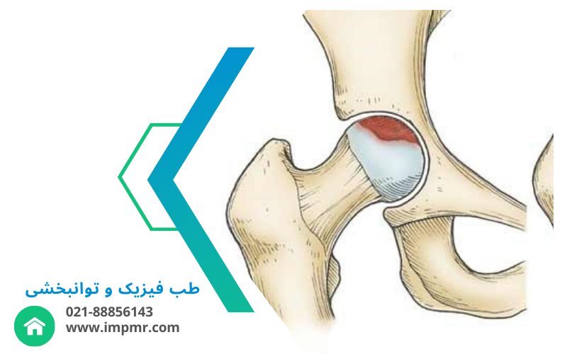 علائم استئونکروز هیپ