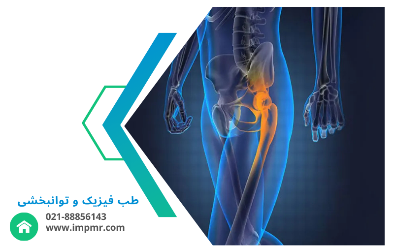 استئونکروز هیپ یا سیاه شدن سر استخوان ران: علل، علائم و درمان‌ها