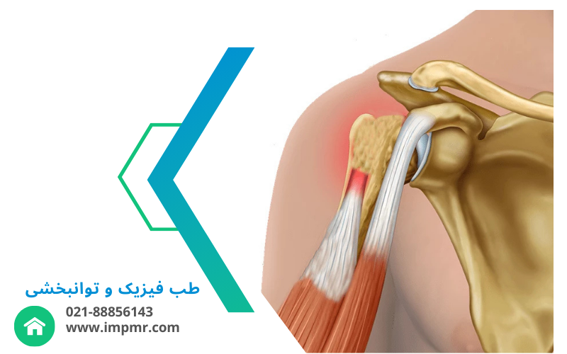 درمان پارگی تاندون عضله دو سر بازویی در آرنج